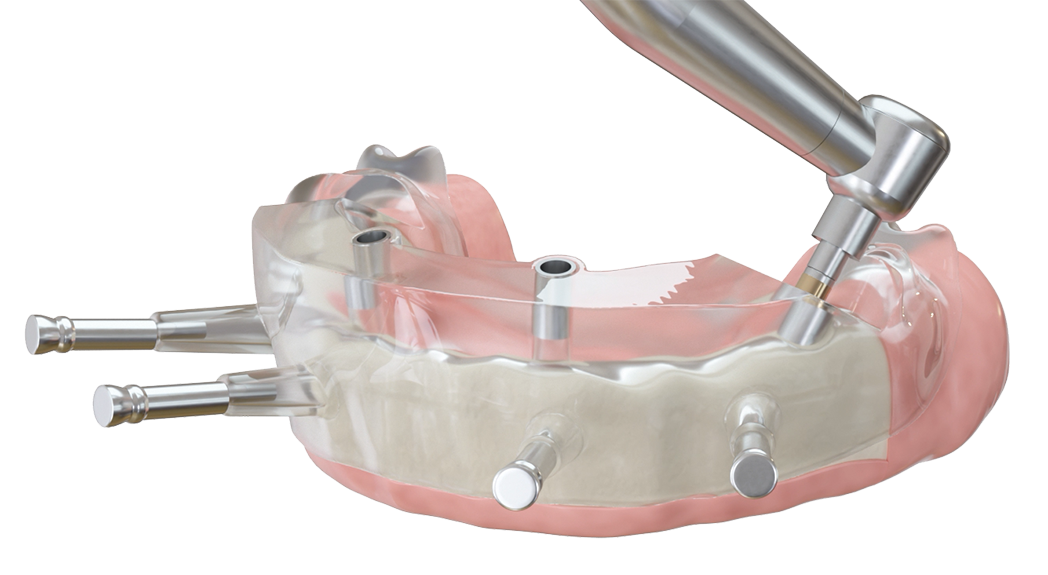 Präzise 3D-Planung von Implantaten durch schablonengeführte Implantatinsertion