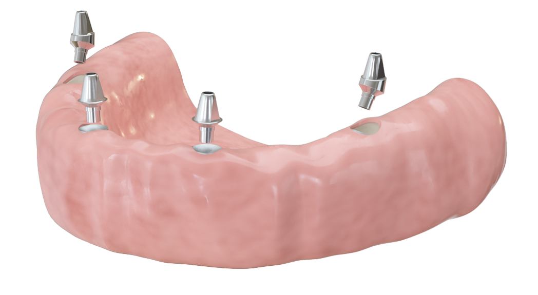 Beim Prinzip "Feste Zähne an einem Tag" werden Aufbauten auf die Implantate gesetzt.